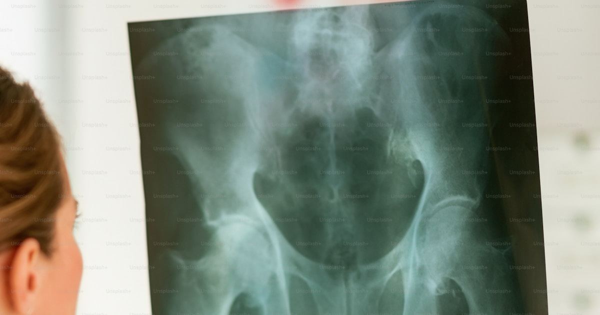 Doctor reviewing a pelvic X-ray during an osteoporosis and bone density assessment